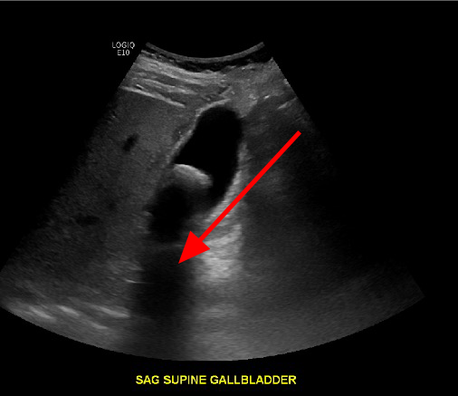 Posterior Acoustic Shadowing